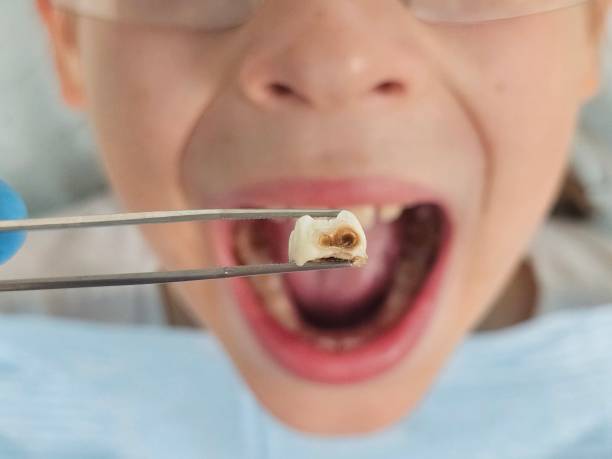 Best Emergency Dental Care for Broken or Chipped Teeth in Patterson, LA